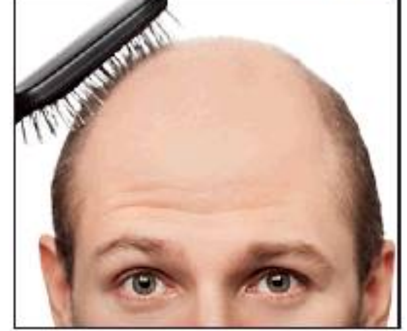 New cure for baldness on the way - Times of India New cure for baldness on the way - Times of India