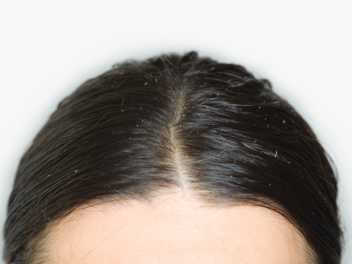 Scalp Pain and Soreness Causes