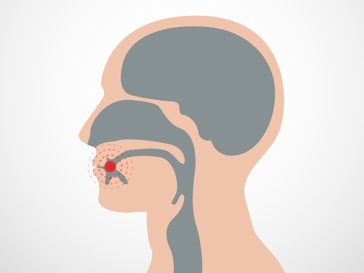 What Is Cancer Of The Larynx Laryngeal And Hypopharyngeal Cancer