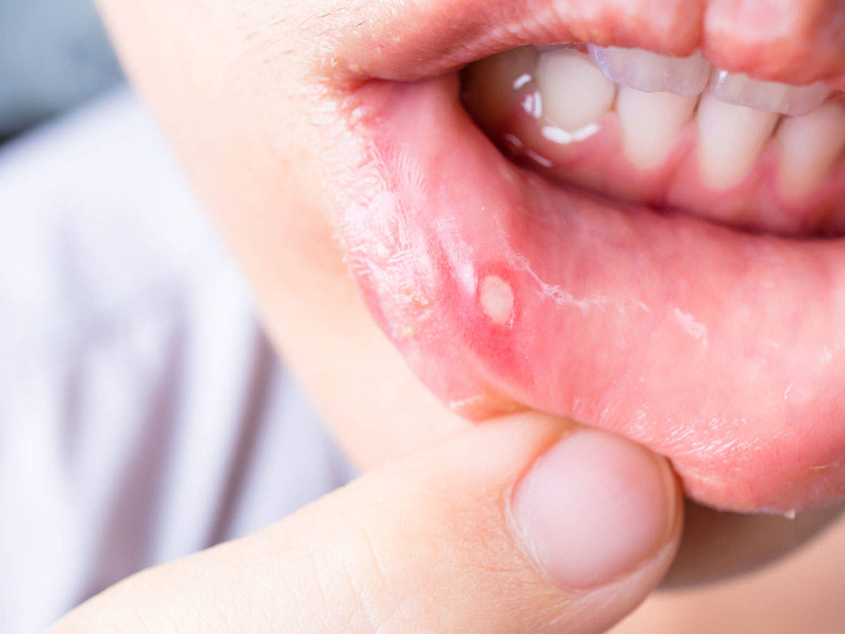 Here&#39;s what you can eat to cure mouth ulcers - Times of India