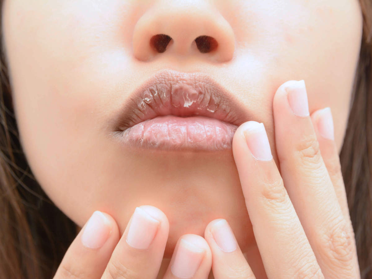 How to treat dry and chapped lips using home remedies - Times of India