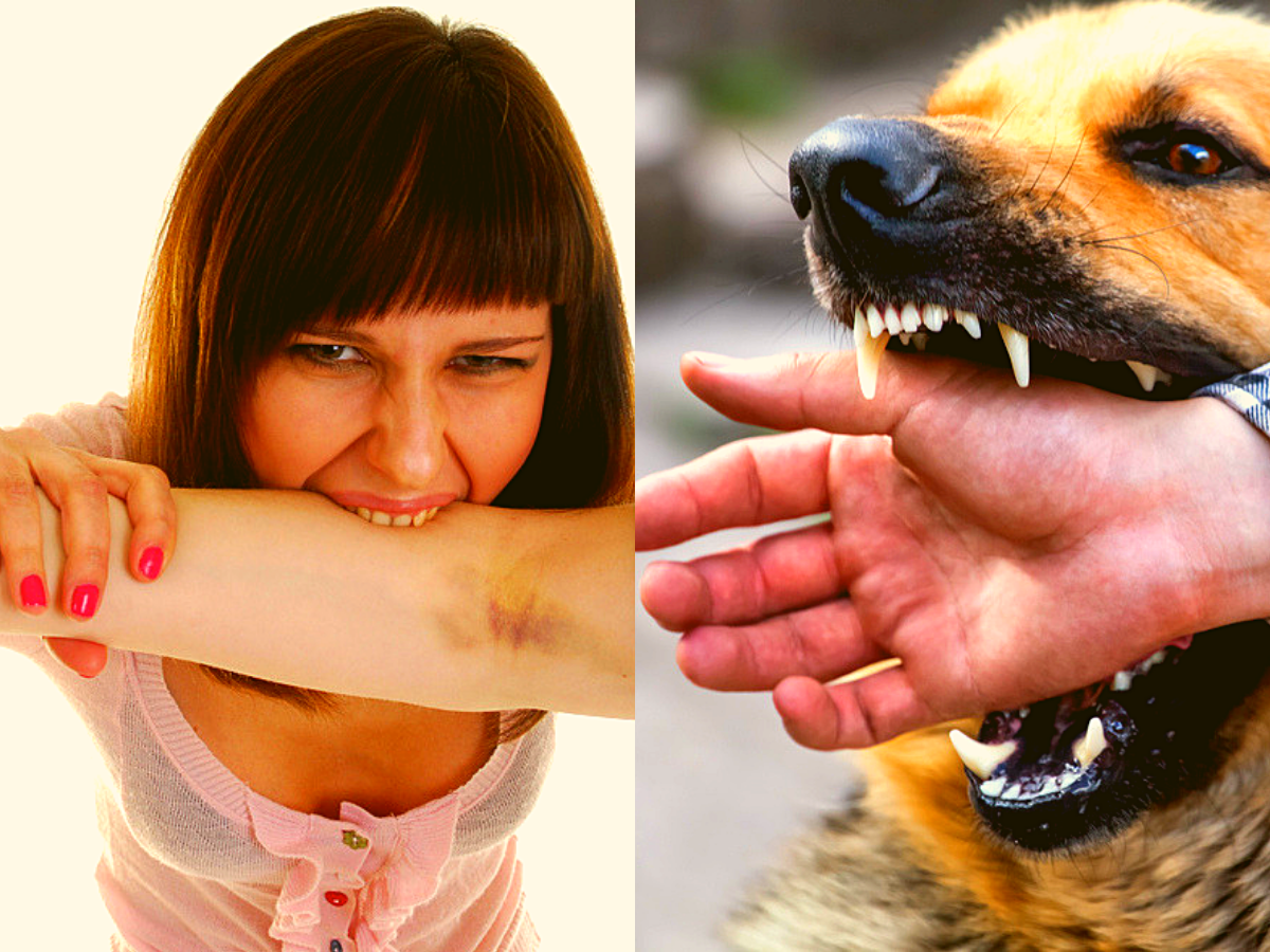 Are human bites as dangerous as a dog bite? We tell you - Times of India