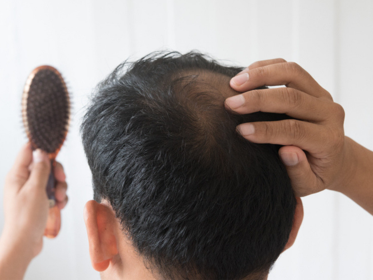 Eat these fruits to prevent baldness! - Times of India Eat these fruits to prevent baldness! - Times of India