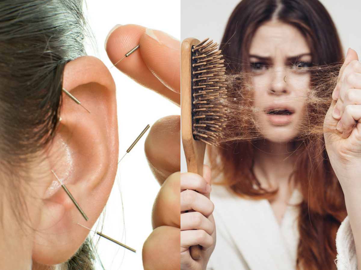 Acupuncture for hair loss: How does it help? - Times of India