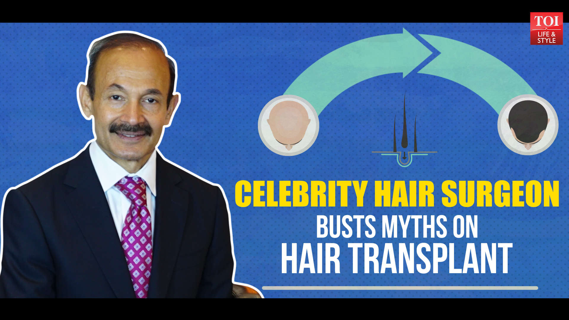 Celebrities Who Underwent A Hair Transplant Surgery