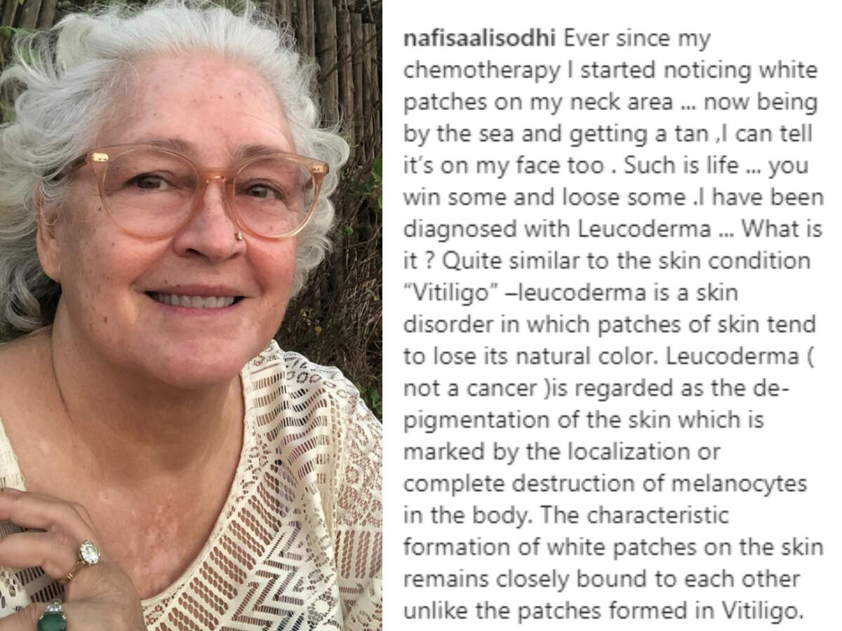 cure vitiligo in 30 days