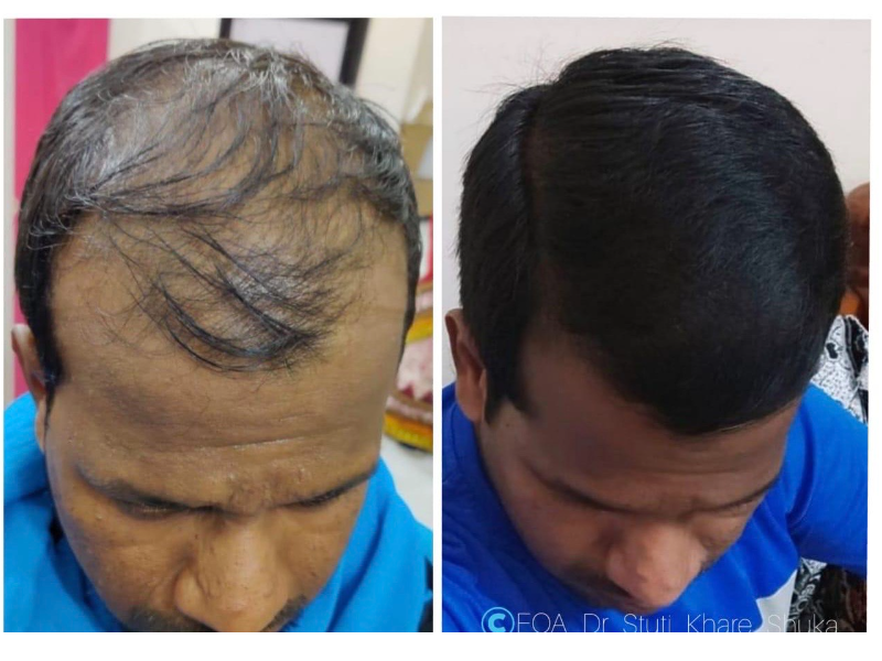 How Can I Prevent Hair Loss By Eating The Right Foods  Plixlife