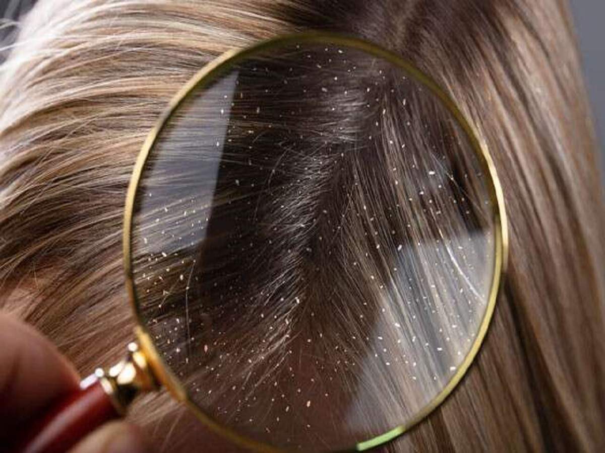 Anti-dandruff conditioner: Say no to flaky, and itchy scalp - Times of India