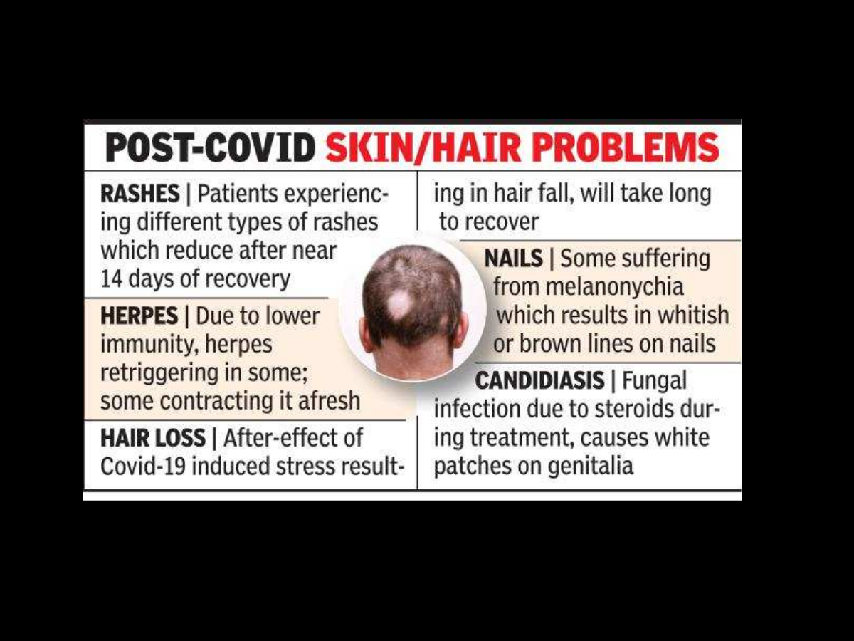 Post Covid hair fall continues for up to 4 months, mostly related to  stress: Doctors | Nagpur News - Times of India