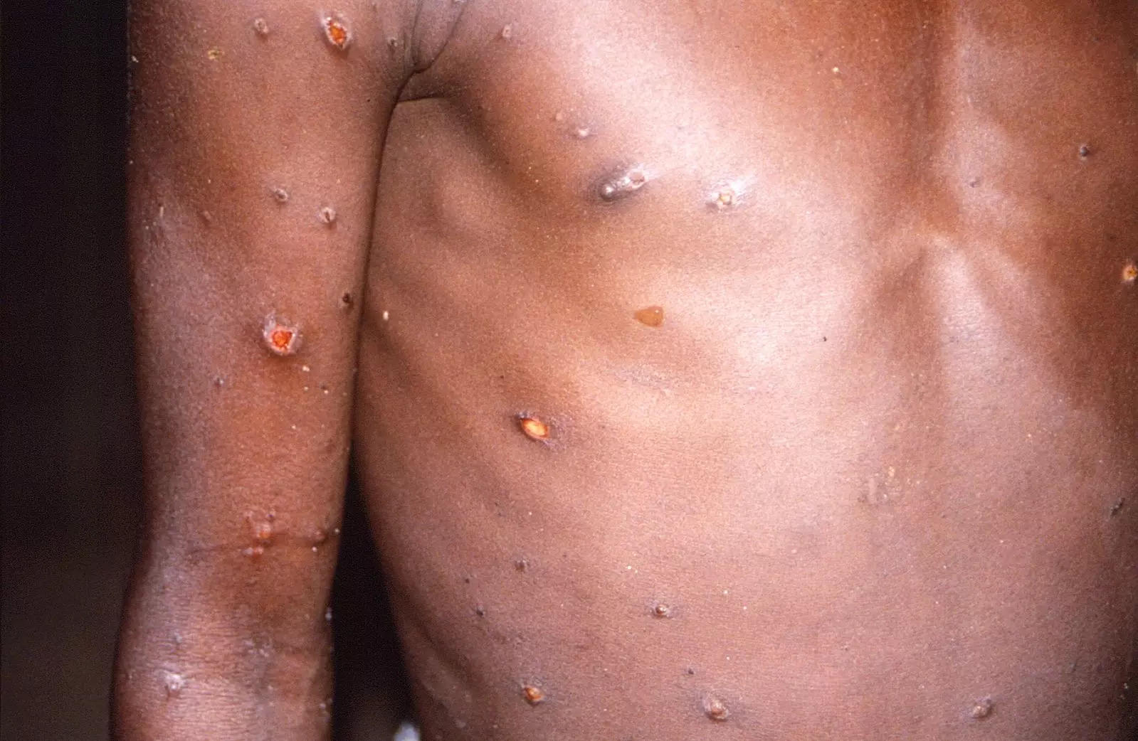 Explainer: What is monkeypox, symptoms and how it spreads - Times of India