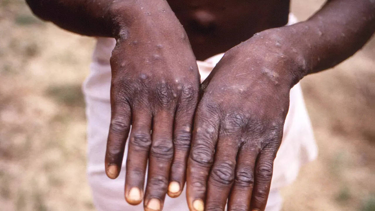 Pakistan reports 1st monkeypox case