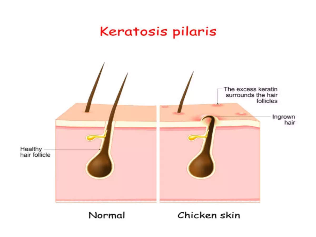 Keratosis Pilaris: This is how you can manage your 'strawberry skin' -  Times of India