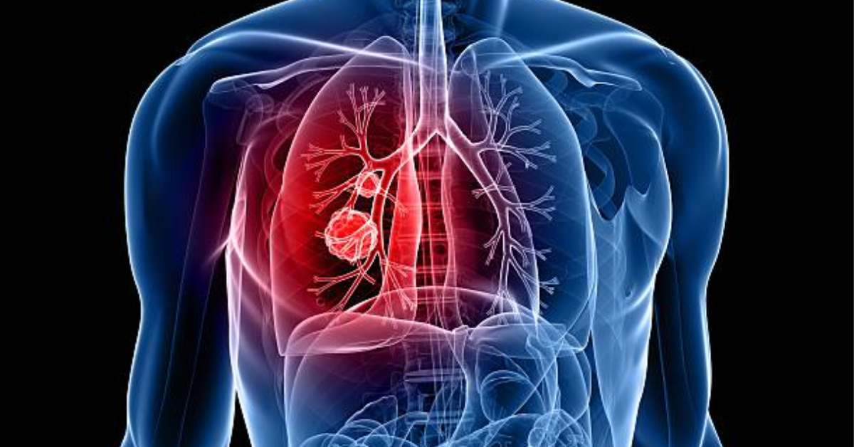 Coronavirus complication: Know how COVID damages your lungs