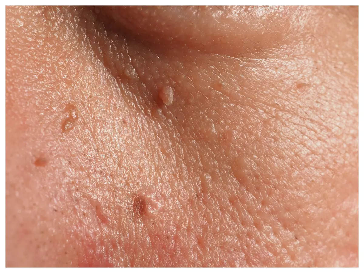 Shetland Minefelt klar Diabetes Symptoms: The skin tags on your body are warning signs of diabetes;  here's what they are and why they appear | - Times of India