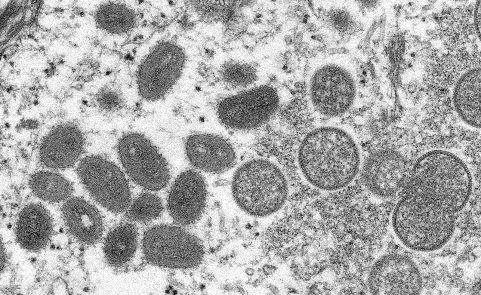 An undated electron microscopy image of mature monkeypox virions (left) and immature virions from a sample of human skin. (File photo: The New York Times)