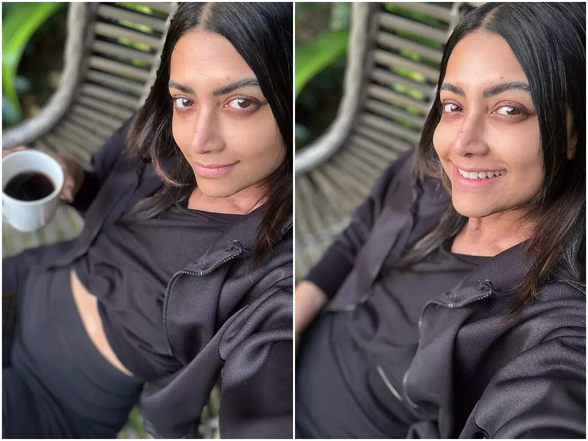 Mamta Mohandas diagnosed with Vitiligo