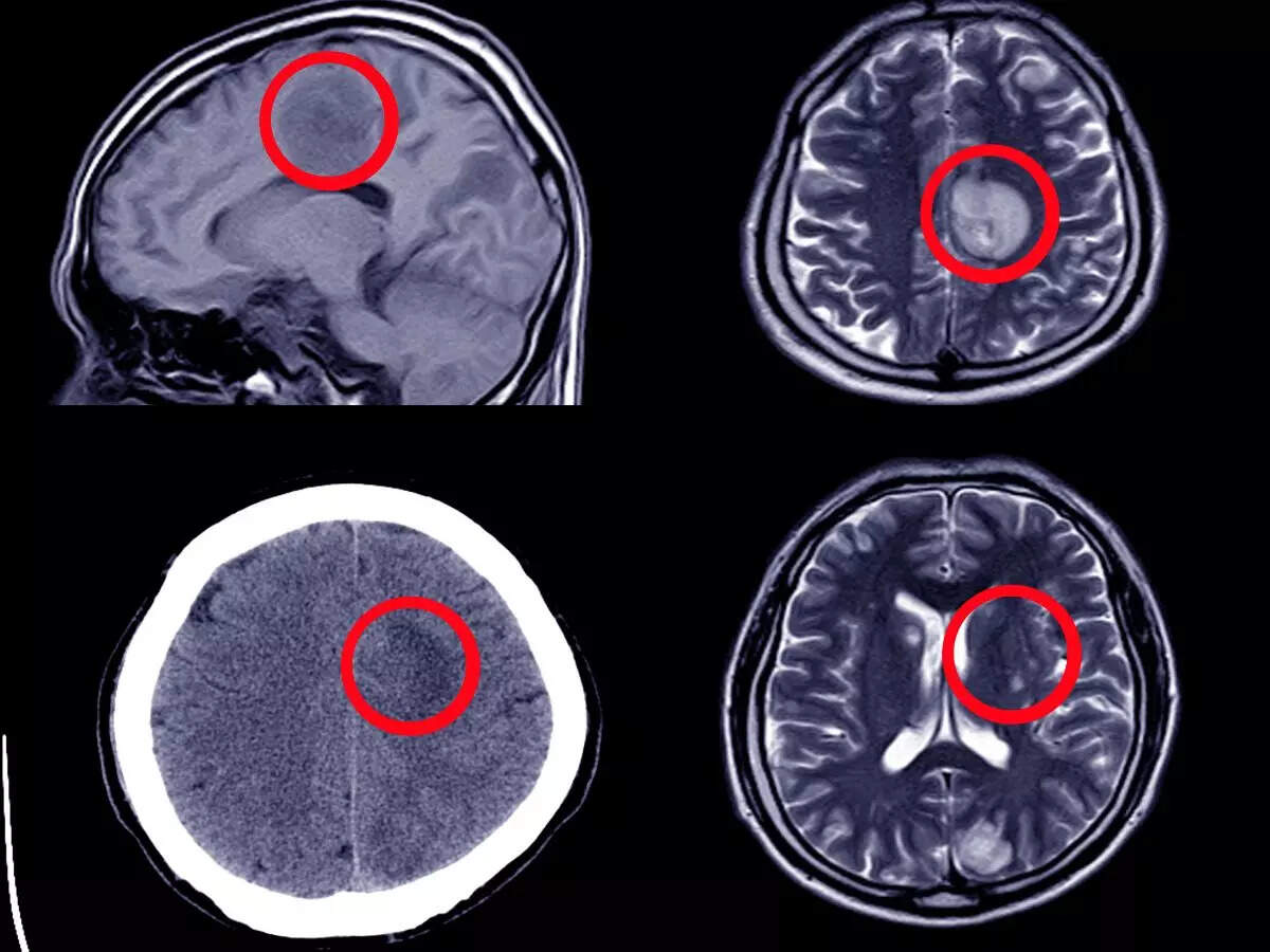 Brain Aneurysm signs not to be ignored 15 Minute News