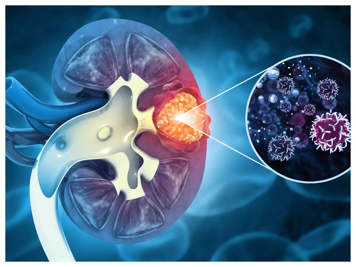 Symptoms of kidney vs gallbladder stones