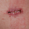 ​Impact of surgery on face​