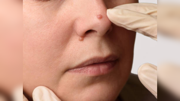 Basal cell carcinoma diagnosed