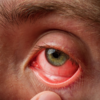 ​​Recognizing the symptoms of retinoblastoma​