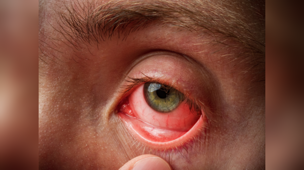Recognizing the symptoms of retinoblastoma