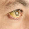​More telling signs of liver damage​