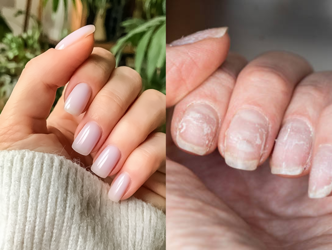 Allergic reaction: Woman's nails started peeling away from her nail bed