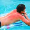 ​Sunburn​