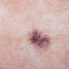 Change in skin texture and color