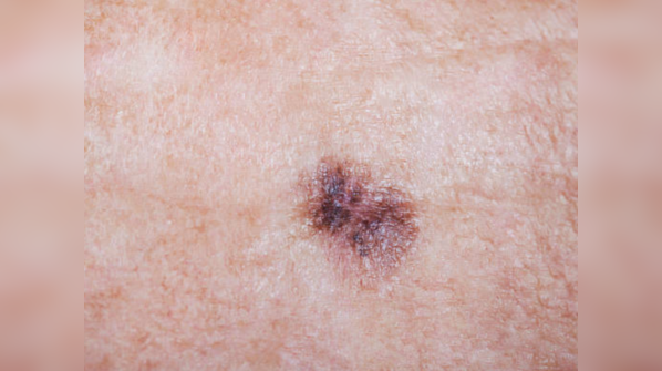 Change in skin texture and color