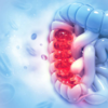 ​Risk of colon cancer increases if...​