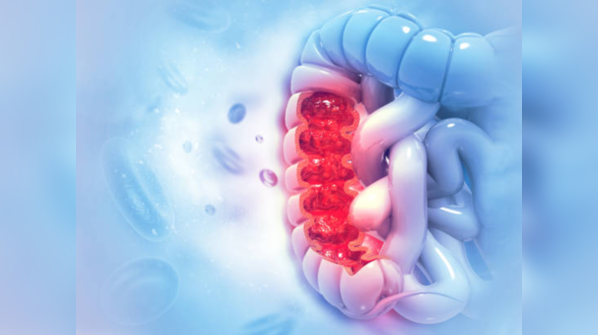 Risk of colon cancer increases if...