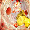 How deposits in arteries put you at risk?
