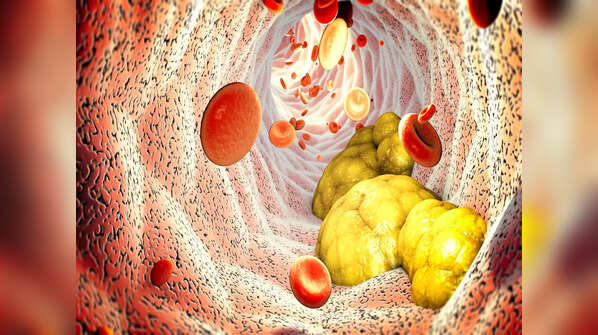 How deposits in arteries put you at risk?
