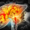 ​What causes fatty liver disease?​