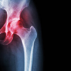 ​Obesity degenerates the bones and joints in the body​