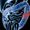 ​How common is constipation, IBS?​