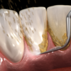 ​What causes gum disease?​