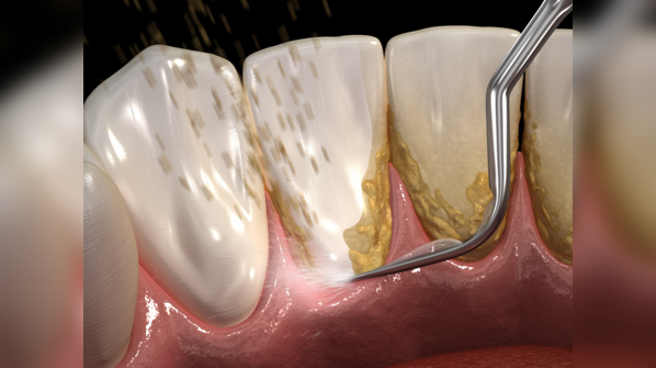 What causes gum disease?