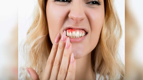 Symptoms of periodontal disease