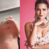 Archana Gautam on her injury in Khatron Ke Khiladi 13