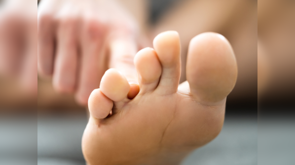 Fungal infection cases are on the rise during monsoon