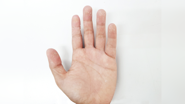 Symptoms of a fungal infection