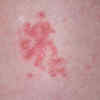 ​Importance of early treatment​