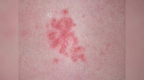 Importance of early treatment