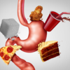 ​​Causes of GERD​
