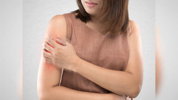 Dengue associated headache feels like discomfort behind the eyes