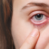 ​​Avoid rubbing or touching the eyes​