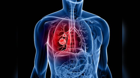 World Lung Cancer Day is observed on August 1
